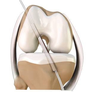 ACL Reconstruction