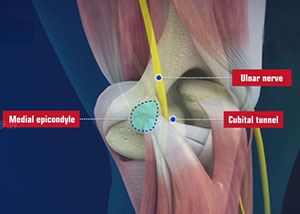 Cubital Tunnel Syndrome 