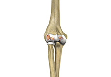 Elbow Arthritis