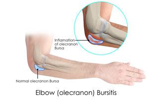 Elbow (Olecranon) Bursitis