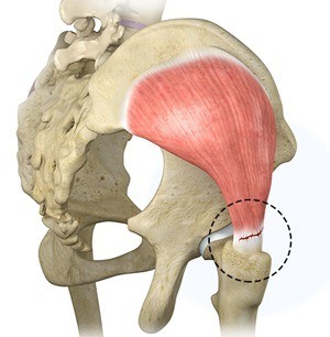 Gluteus Tendon Tear