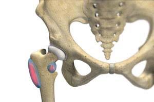 Snapping Hip Syndrome