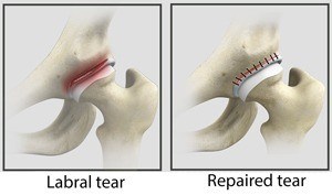 hip-labral-repair