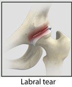 Hip Labral Repair