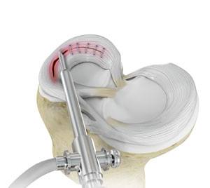 Meniscal Surgery