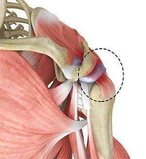 rotator-cuff-pain