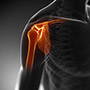 Shoulder Bursitis