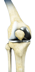 Unicondylar Knee Replacement